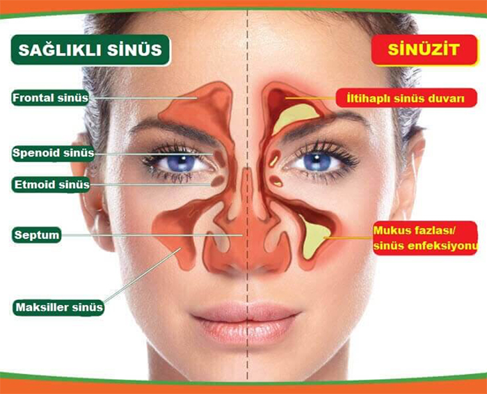 Sinüzit Nedir?